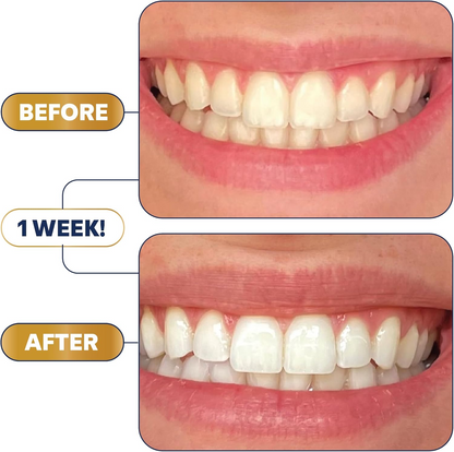 Lumineux® Whitening Strips